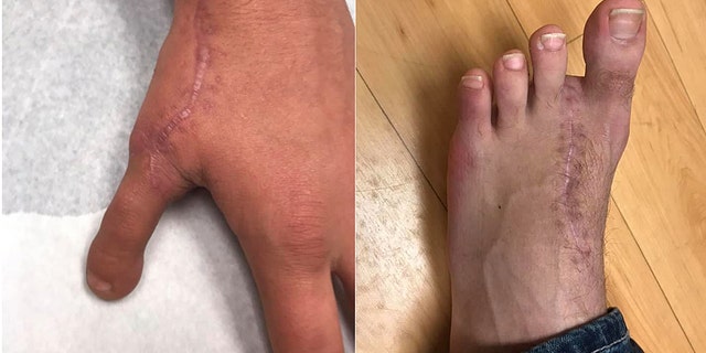 Aiden Adkins's new thumb (L) created from the index toe on his left foot (R).