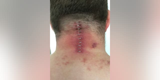 Stuart Clegg following a surgery to treat the nerve damage in his neck.