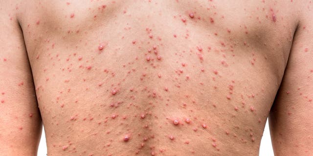 The outbreak of chickenpox occurred at an elementary school in Wisconsin.