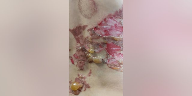 The rubbing alcohol on her skin caught fire, leaving her with bloodied, blistered scars.