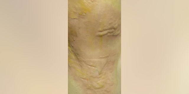 She may suffer permanent scarring as a result, reports say.