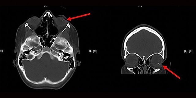 A scan showing where the lead entered the girl's eye.