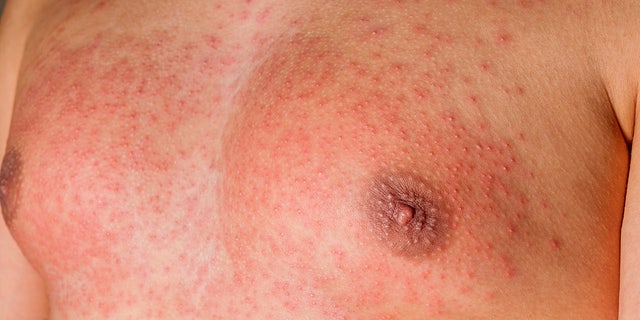 Scarlet fever causes a bright red rash.