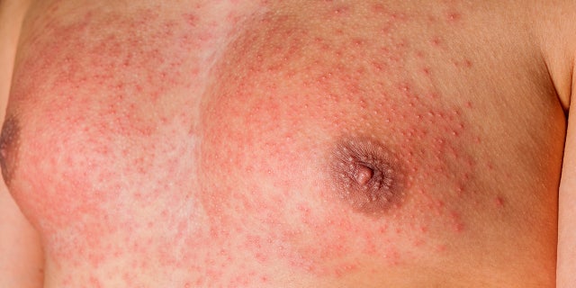 Scarlet fever causes a bright red rash.