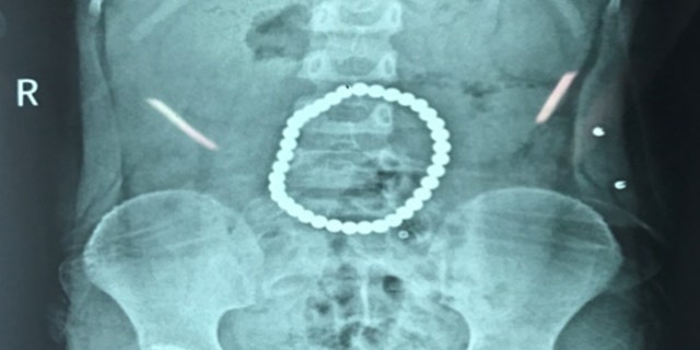 A scan revealed that the balls had connected in her stomach to form a perfect circle.