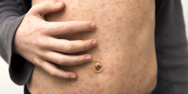The measles is a highly contagious virus.