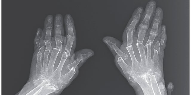 An X-ray of the woman's hands.