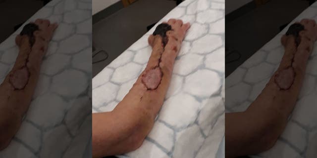 The woman's arm as she battled flesh-eating bacteria.