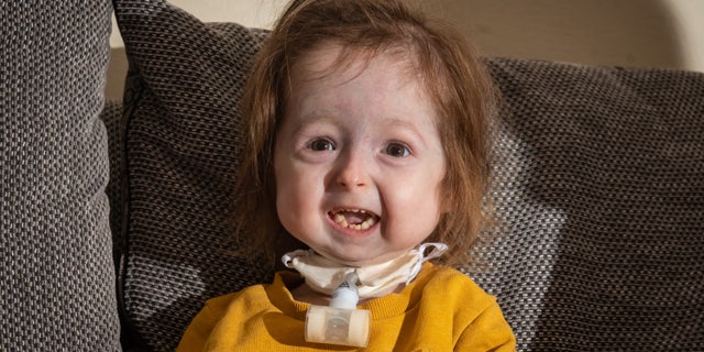 Isla Kilpatrick-Screaton from Leicester, UK, who was born with an allegedly never-before recorded form of mandibuloacral dysplasia.