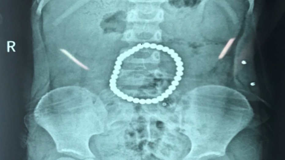 Toddler left with holes in stomach after swallowing 37 balls