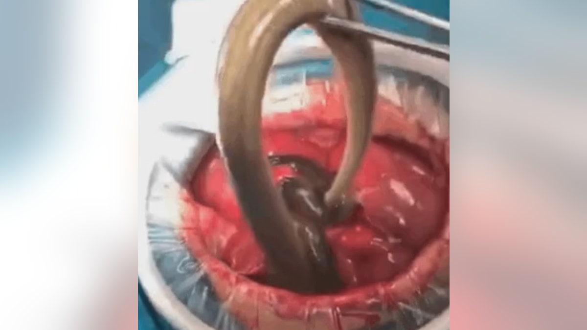 Surgeons had to open his abdomen and remove the sea creatures after they ate a hole through his intestines and caused a massive infection, which could have killed him.