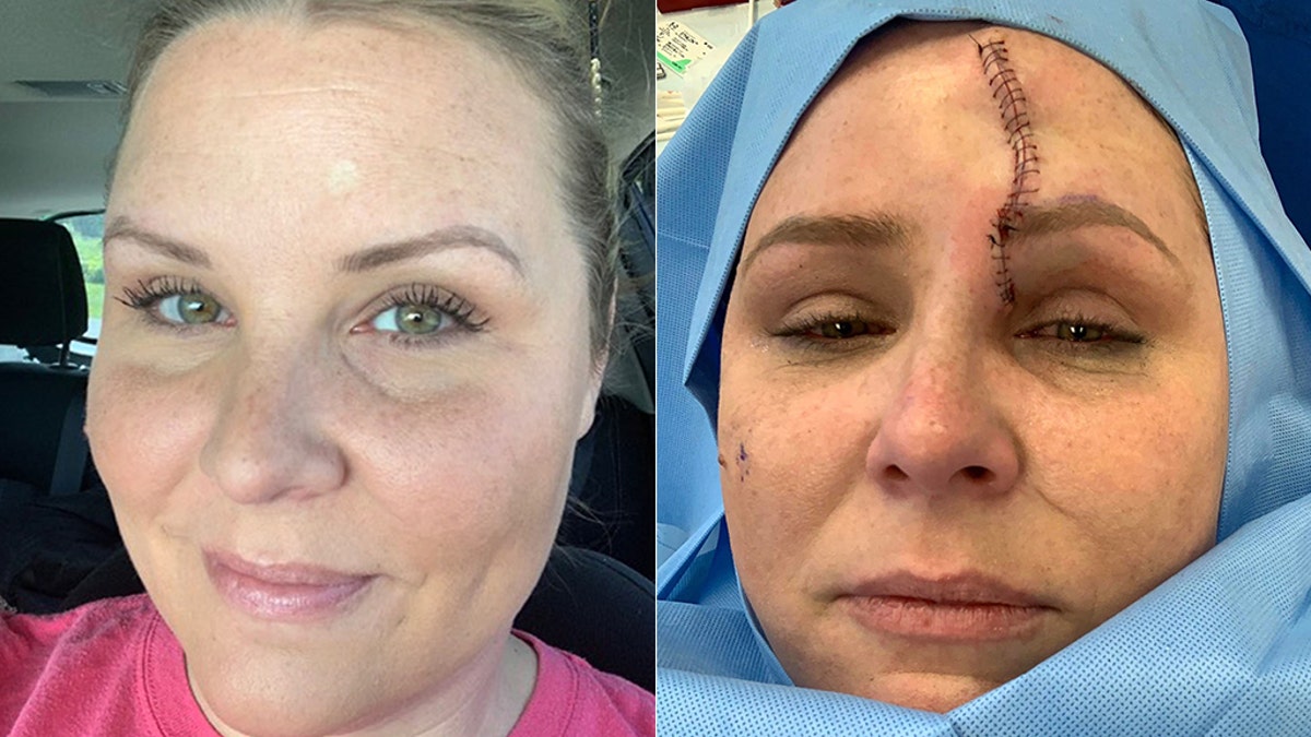 Carrie Searcy with the white spot on her forehead (left) that she would later learn was skin cancer.