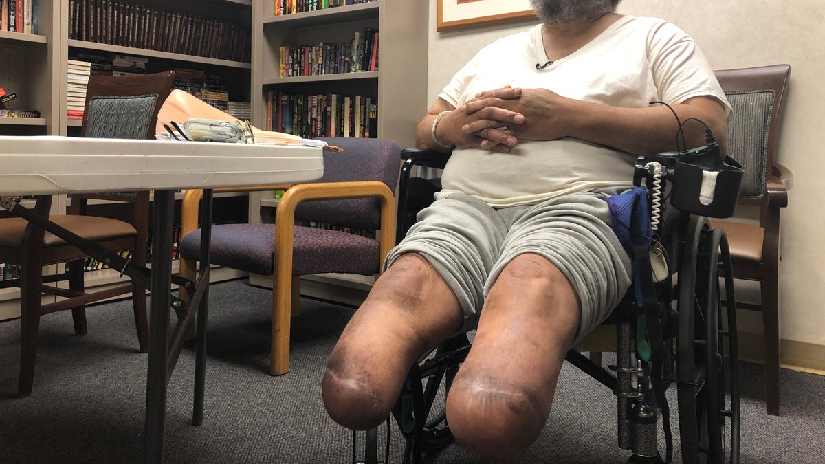 Jerry Holliman shows where doctors had to amputate his legs below the knee.  (Fox News/Charles Watson)