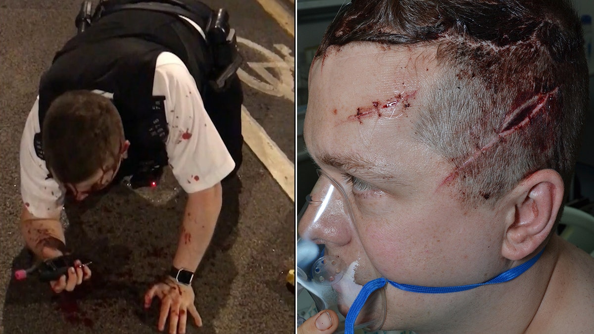 Outten is pictured left after discharging his Taser and stopping Rodwan's assault. He is pictured right following surgery for his multiple injuries.