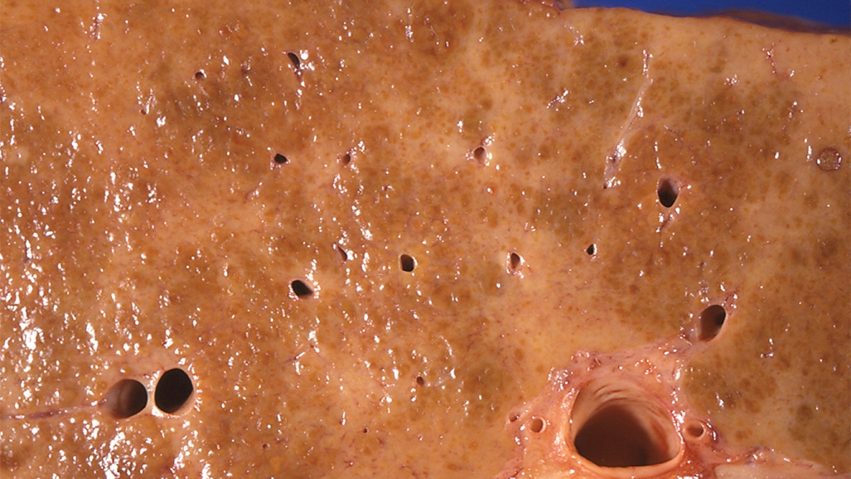 This 1971 photo made available by the Centers for Disease Control and Prevention shows an alcoholic cirrhosis liver specimen from an autopsy showing a dense network of scar tissue in response to chronic injury from alcohol abuse. (Dr. Edwin P. Ewing, Jr./CDC via AP)