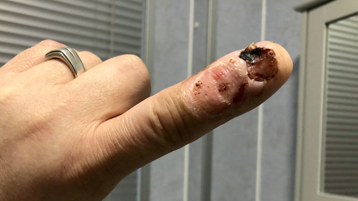Man's nail-biting habit leads to severe infection, emergency surgery | Fox  News