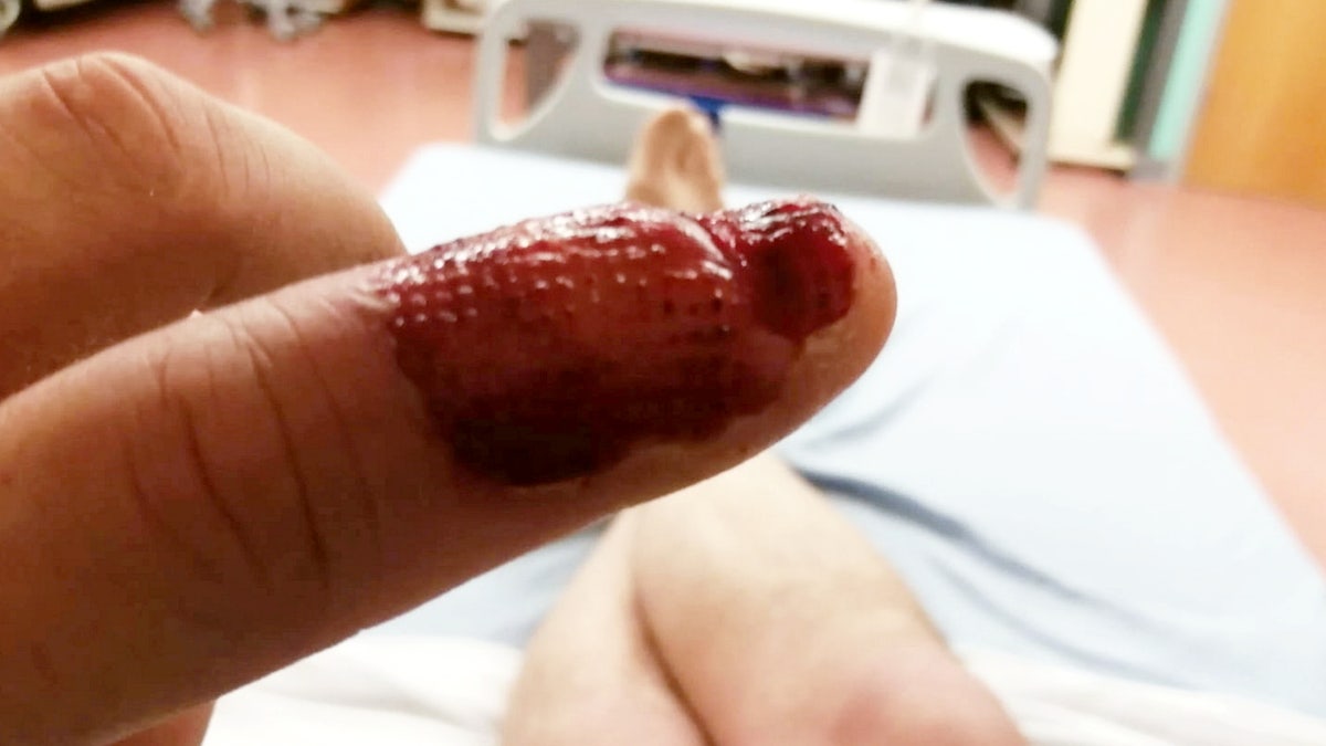 Steven MacDonald, 48, was rushed to hospital just days after noticing his left index finger had become infected.