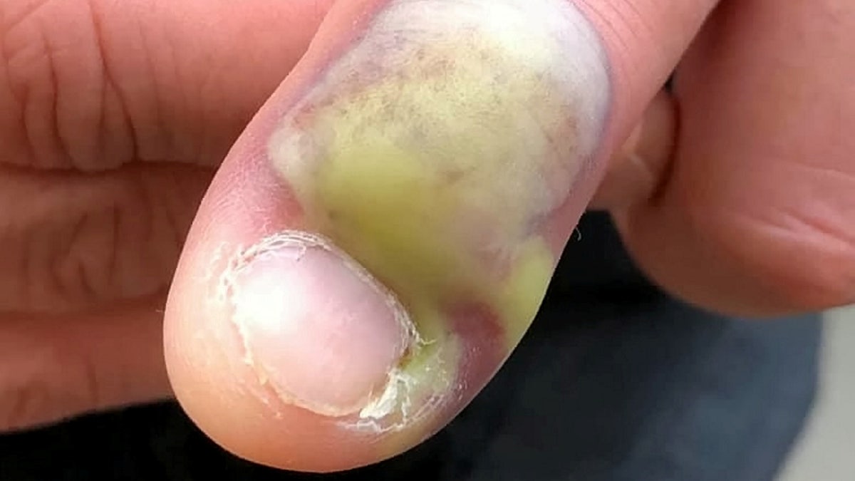 Infected Hangnail: Signs, Treatment, and Prevention