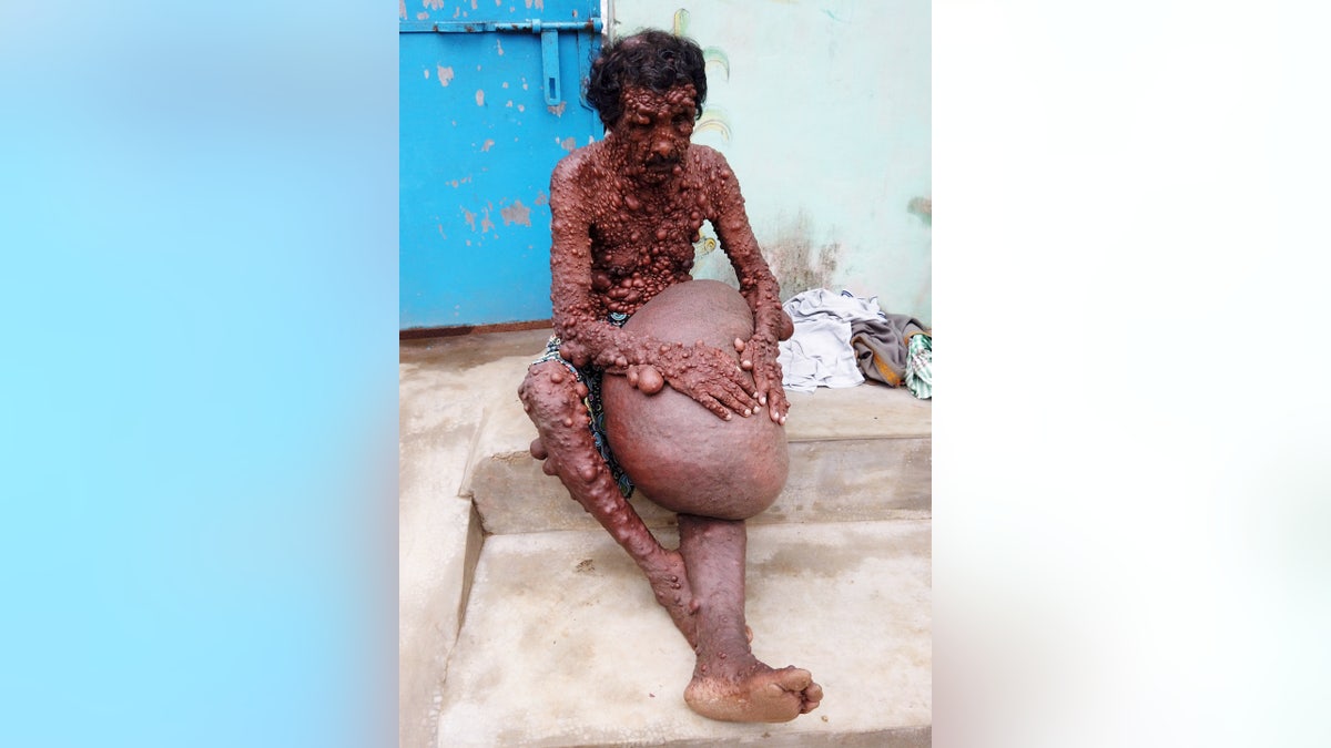In addition to the thousands of tumors, the condition has also caused his leg to swell to a massive 56 pounds.