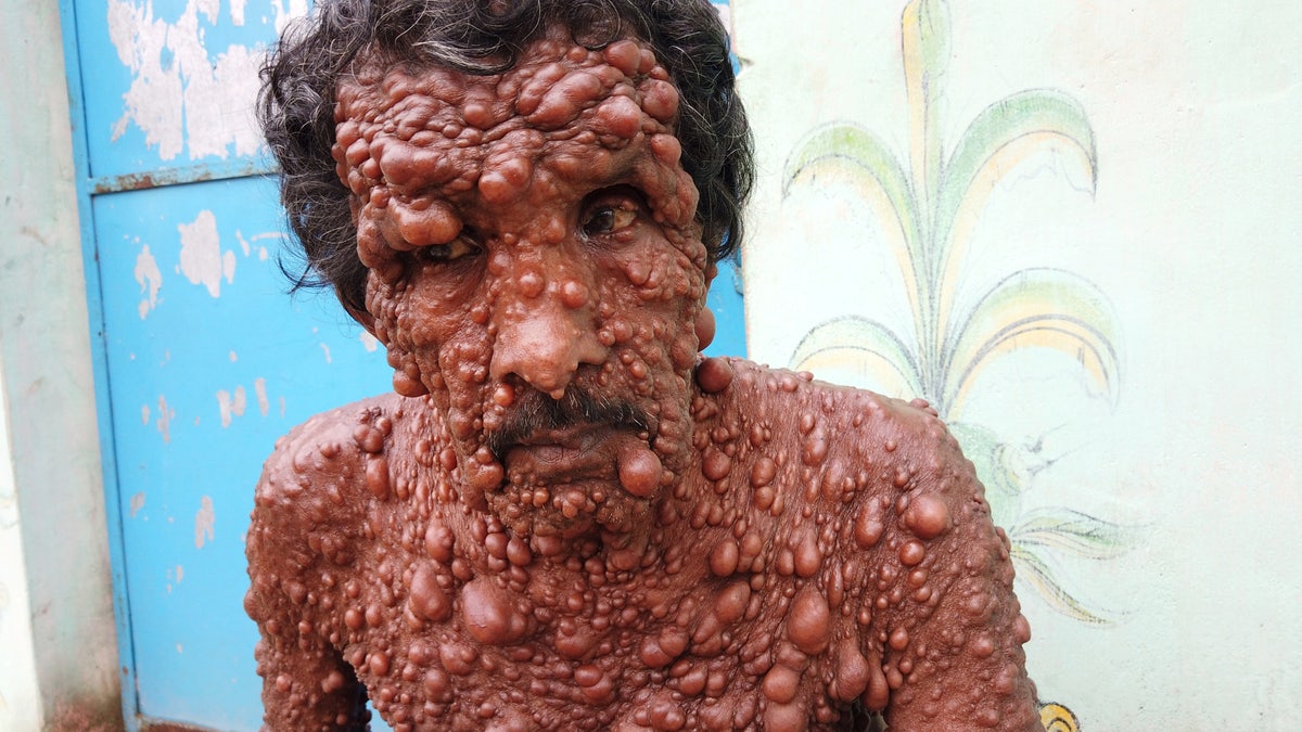 Diwaker Bisoye said he is treated worse than "a dirty stray animal" by people who don't understand his condition.
