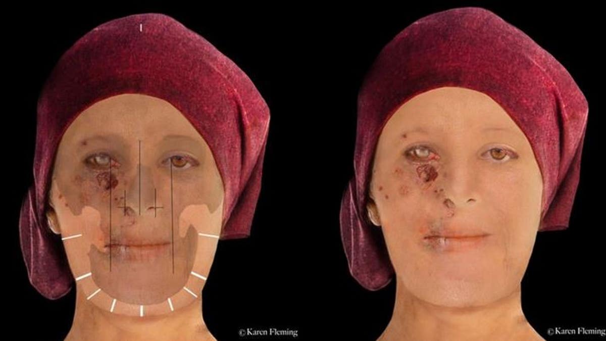 Leprosy mutilated the face of this high-status woman, who lived from the mid-15th to the 16th century in Scotland. (The City of Edinburgh Council)