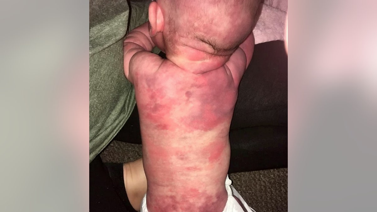 The birthmark covers 90 percent of her body, according to her mom. (SWNS)