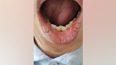Mouth lesions may be a new coronavirus symptom, study suggests