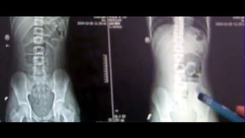 Bubble tea causes blockage in teen's bowels: report