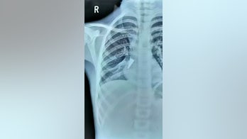 Doctor pulls pen cap from girl's lung after she accidentally inhaled it weeks ago