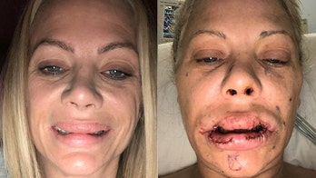 Connecticut mom 'feels ugly and unattractive' after plastic surgeries left her with lumpy lips, misshapen nose