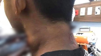 Gruesome photo shows needlefish impaled in teen's neck: report