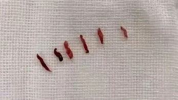 'Widowmaker' heart attack patient has 6 blood clots pulled from artery