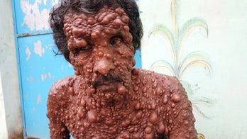 Man covered in thousands of tumors says he's treated 'worse than stray animal'