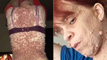 Mom covered in thousands of tumors due to rare genetic disorder: 'It's really rough and depressing'