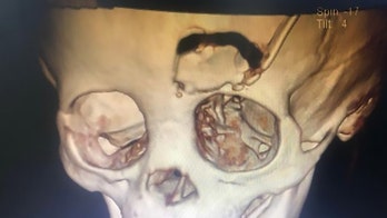 Toddler fractures skull after pencil impales eye, report says