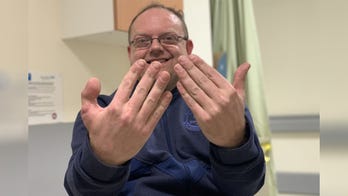 Cobbler's thumb cut off during shoe accident, replaced by his big toe