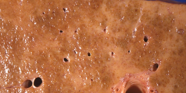 This 1971 photo made available by the Centers for Disease Control and Prevention shows an alcoholic cirrhosis liver specimen from an autopsy showing a dense network of scar tissue in response to chronic injury from alcohol abuse.