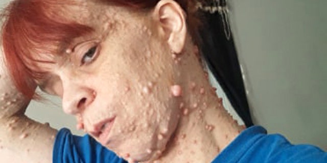 Ashley Jernigan, 35, is covered in thousands of benign tumors.