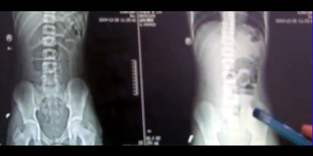 Doctors found two objects obstructing the teen's bowels, which they learned were tapioca balls.
