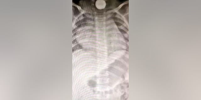 His relatives saw him swallow the battery, pictured lodged in his throat, and mistakenly believed that he had thrown it back up.