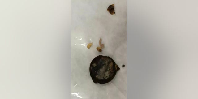 The battery, pictured after removal, had caused extensive damage to his esophagus.