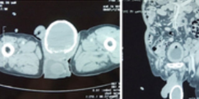 A fluid-filled sac had formed around the man's testicle and began to calcify. 