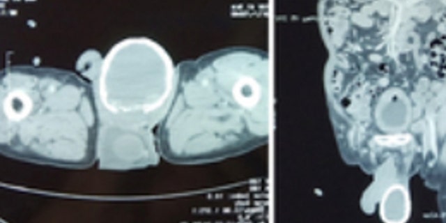 A fluid-filled sac had formed around the man's testicle and began to calcify. 