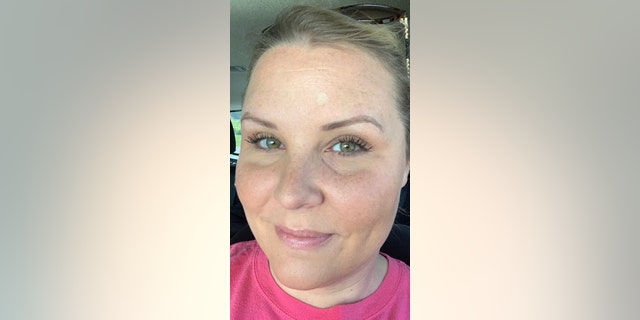 Carrie Searcy's waxy looking spot that she couldn't get rid of. (Caters News Agency)