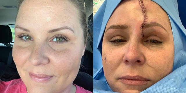 Carrie Searcy with the white spot on her forehead (left) that she would later learn was skin cancer.