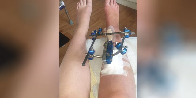 According to SWNS, Garrity broke her fibula in five places and her tibia in one. She also fractured the side of her foot and cracked her ankle bone.