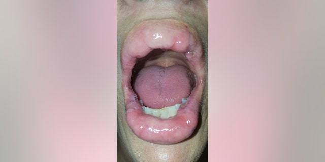 Gonzalez, pictured after the first surgery in which she asked the doctor to lessen the look of her lips, said she wishes she never touched her face in the first place.