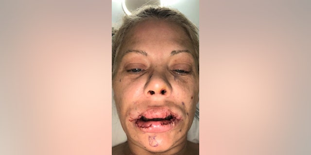 Her lips have been left covered in scars and are currently lopsided after she suffered a series of setbacks including infections.