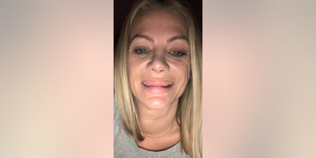 Gonzalez, who has already undergone two procedures to correct her lips, will go back for a third next month to make her lips smaller.
