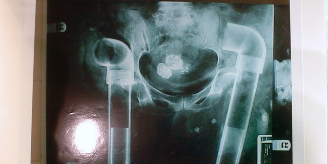 X-ray image showing how PVC pipe replaced bones removed from bodies is on display at a news conference during which Brooklyn prosecutors announced they were charging Michael Mastromarino, Joseph Nicelli and two lesser principals with 122 counts of body-stealing, grand larceny, forgery and other charges. The body-parts-for-sale ring made $4.7 million over four years by illegally obtaining bodies and selling body parts to hospitals and other health-care providers for transplant into unsuspecting patients.